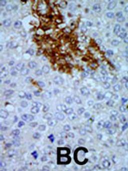 Formalin-fixed and paraffin-embedded human cancer tissue reacted with the primary antibody, which was peroxidase-conjugated to the secondary antibody, followed by AEC staining. BC = breast carcinoma; HC = hepatocarcinoma.