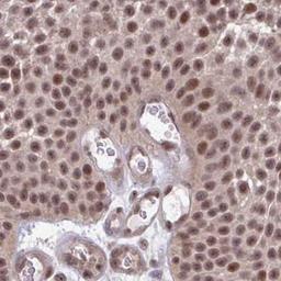 Immunohistochemistry: SETBP1 Antibody [NBP2-31667] - urothelial cancer