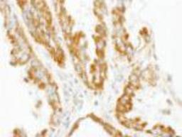 Immunohistochemistry-Paraffin: CNOT3 Antibody [NBP1-21396] - FFPE section of human lung carcinoma. Antibody: Affinity purified rabbit anti-CNOT3 used at a dilution of 1:250. Detection: DAB staining using Immunohistochemistry Accessory Kit