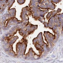 Immunohistochemistry: ALDH3B1 Antibody [NBP2-32638] - ovarian cancer