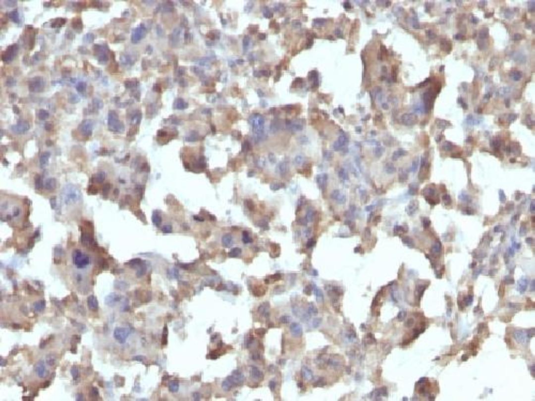 Immunohistochemical staining of human Histiocytoma tissue using TNF antibody