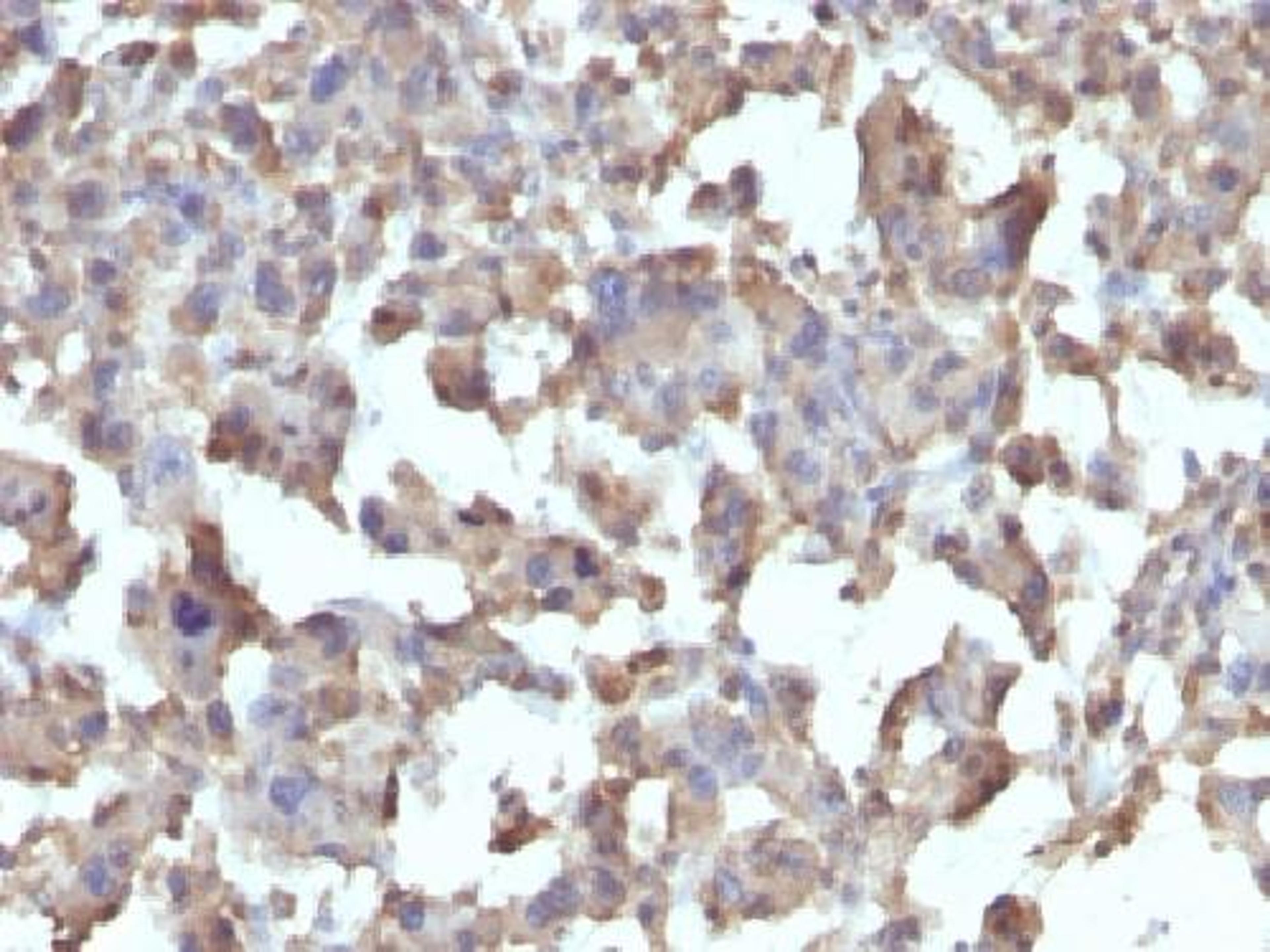 Immunohistochemical staining of human Histiocytoma tissue using TNF antibody