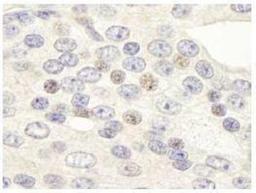 Immunohistochemistry-Paraffin: ZNF592 Antibody [NB100-74657] - Detection of Human ZNF592 by IHC  Sample: FFPE section of human prostate carcinoma. Affinity purified rabbit anti-ZNF592 used at a dilution of 1:250. Detection: DAB staining using IHC Accessory Kit