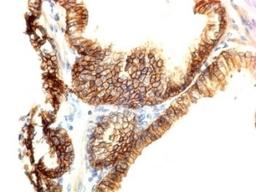 Formalin-fixed, paraffin-embedded human colon carcinoma stained with CDH1 antibody.