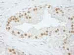 Immunohistochemistry-Paraffin: CPSF73 Antibody [NB100-57529] - FFPE section of human prostate carcinoma.   Affinity purified rabbit anti-CPSF73 used at a dilution of 1:250.