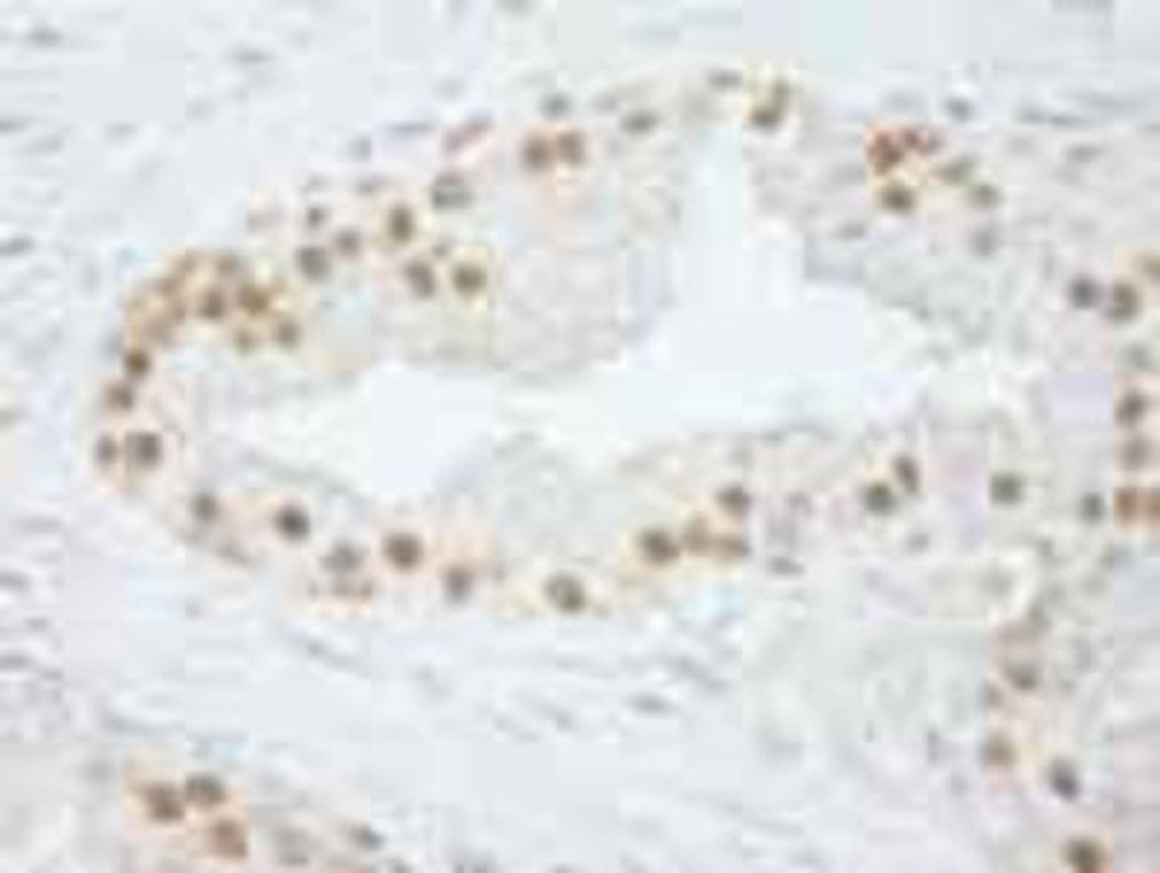 Immunohistochemistry-Paraffin: CPSF73 Antibody [NB100-57529] - FFPE section of human prostate carcinoma.   Affinity purified rabbit anti-CPSF73 used at a dilution of 1:250.