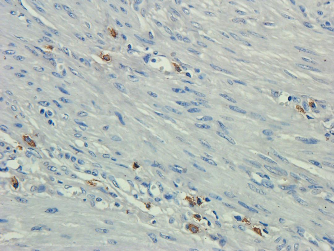 IHC-P staining of human endometrial cancer tissue using CD35 antibody (dilution at 2.5 ug/ml)