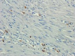 IHC-P staining of human endometrial cancer tissue using CD35 antibody (dilution at 2.5 ug/ml)