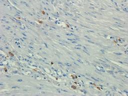 IHC-P staining of human endometrial cancer tissue using CD35 antibody (dilution at 2.5 ug/ml)