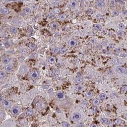 Immunohistochemistry: IGFL2 Antibody [NBP2-32430] - liver cancer