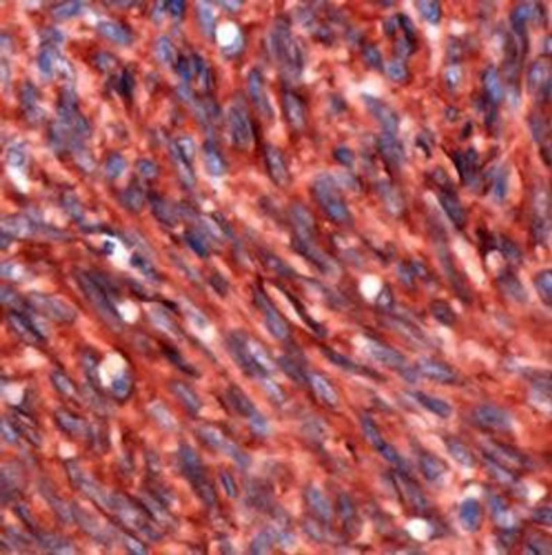 Immunohistochemistry-Paraffin: DOG1/TMEM16A Antibody (SP31) [NBP1-49799] - Human Gastrointestinal Stromal Tumor