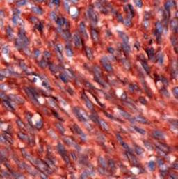 Immunohistochemistry-Paraffin: DOG1/TMEM16A Antibody (SP31) [NBP1-49799] - Human Gastrointestinal Stromal Tumor