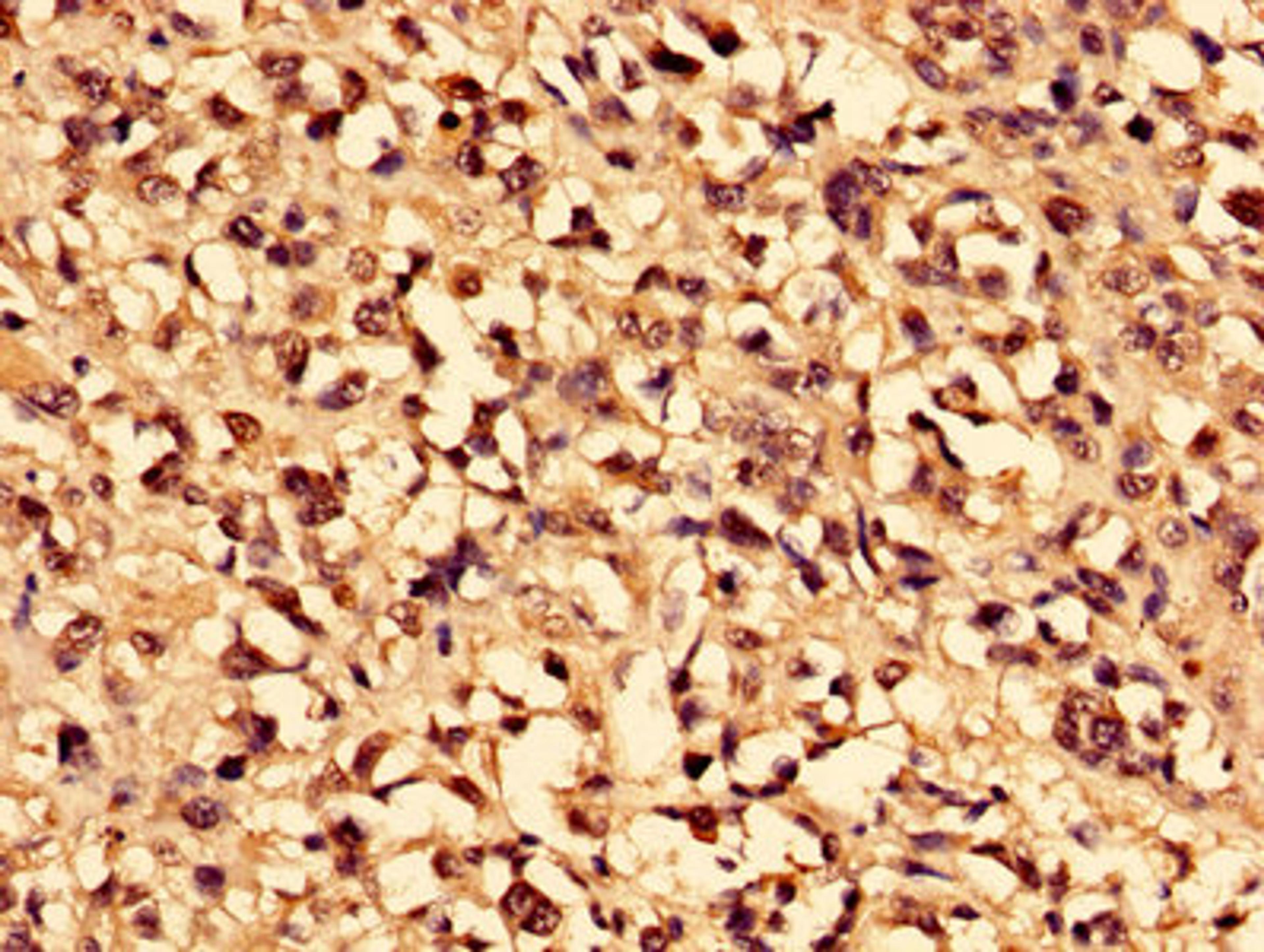 Immunohistochemistry of paraffin-embedded human melanoma using CSB-PA004364HA01HU at dilution of 1:100