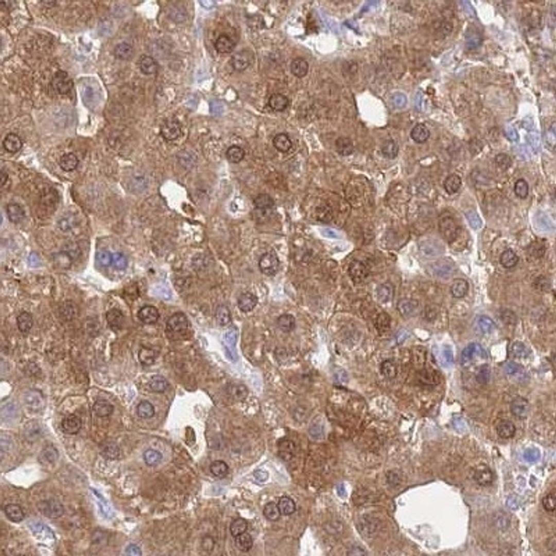 Immunohistochemistry: Phosphoglucomutase 5 Antibody [NBP2-32043] - liver cancer