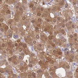 Immunohistochemistry: Phosphoglucomutase 5 Antibody [NBP2-32043] - liver cancer