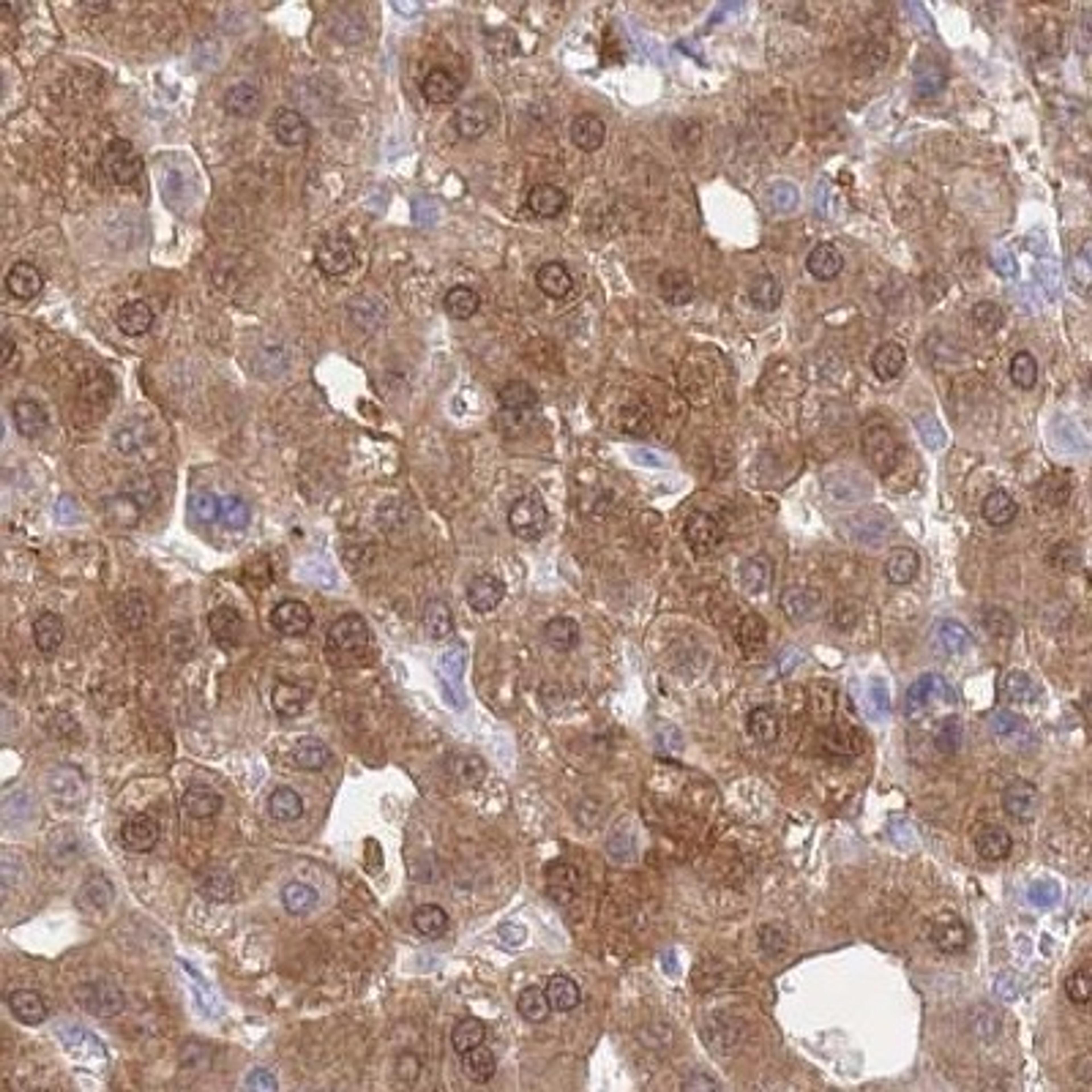 Immunohistochemistry: Phosphoglucomutase 5 Antibody [NBP2-32043] - liver cancer