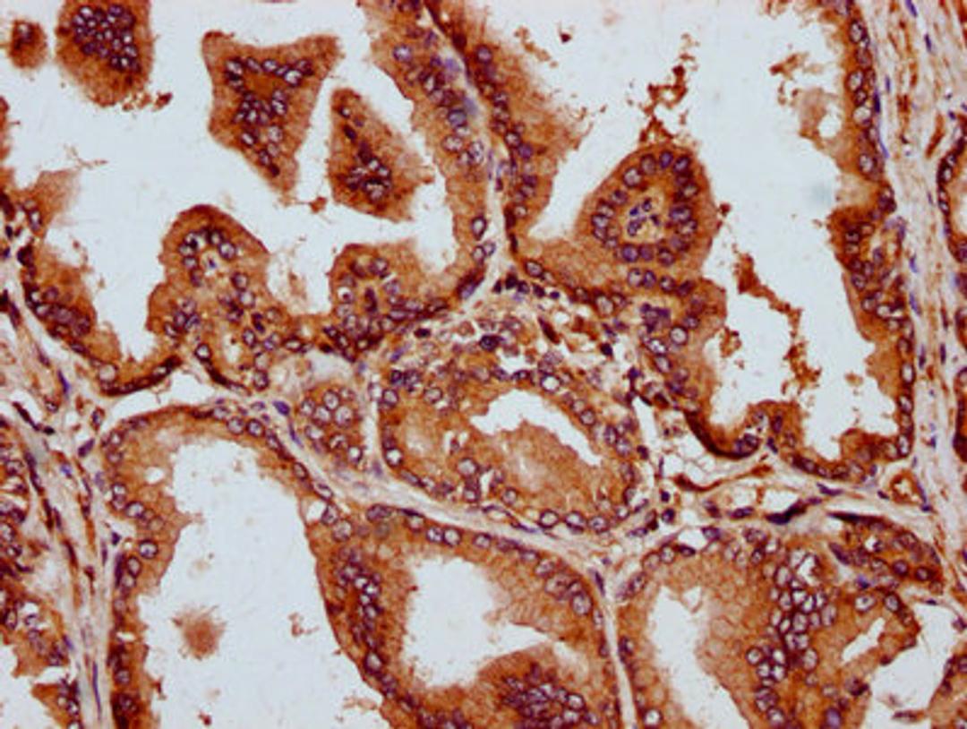 IHC image of CSB-PA738576LA01HU diluted at 1:300 and staining in paraffin-embedded human prostate tissue performed on a Leica BondTM system. After dewaxing and hydration, antigen retrieval was mediated by high pressure in a citrate buffer (pH 6.0). Section was blocked with 10% normal goat serum 30min at RT. Then primary antibody (1% BSA) was incubated at 4°C overnight. The primary is detected by a biotinylated secondary antibody and visualized using an HRP conjugated SP system.