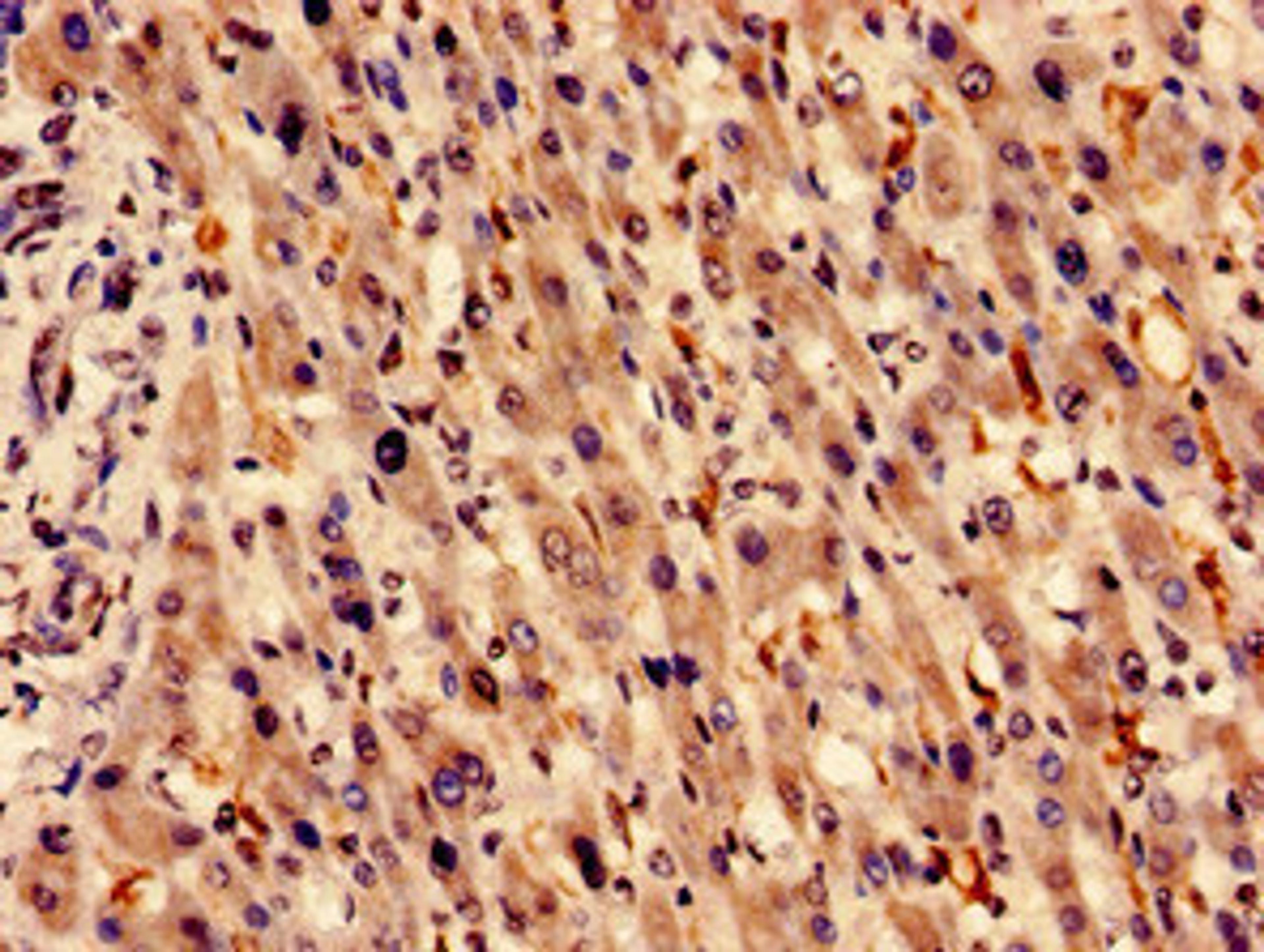 Immunocytochemistry analysis of human liver cancer using CSB-PA010583LA01HU at dilution of 1:100