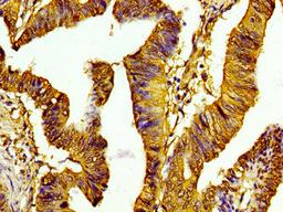 Immunohistochemistry of paraffin-embedded human colon cancer using CSB-PA010378PA118nme1HU at dilution of 1:100