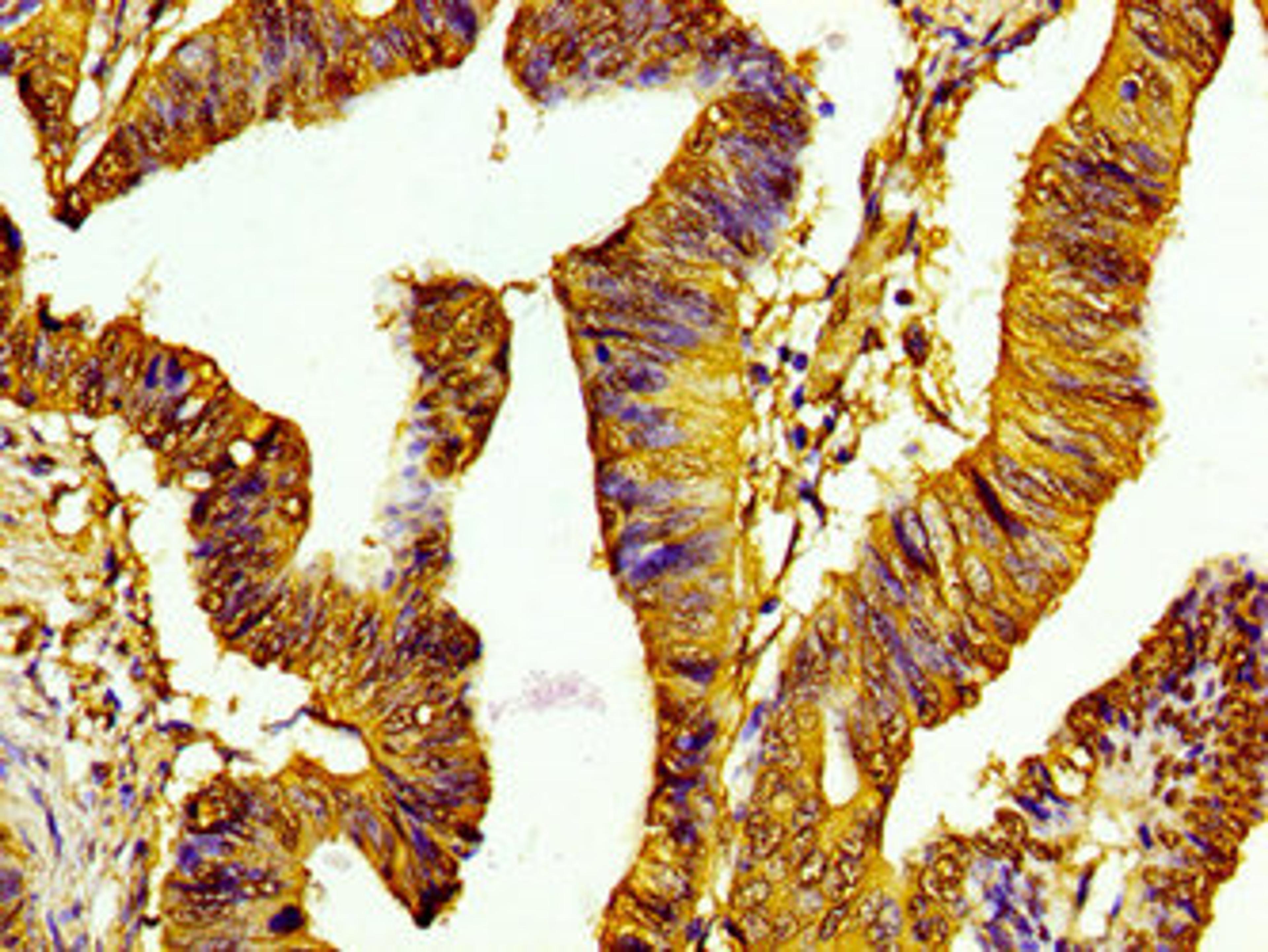 Immunohistochemistry of paraffin-embedded human colon cancer using CSB-PA010378PA118nme1HU at dilution of 1:100