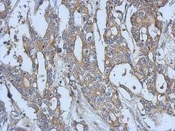 Immunohistochemistry-Paraffin: EPH Receptor A3 Antibody [NBP2-16346] - Immunohistochemical analysis of paraffin-embedded Gastric ca, using antibody at 1:500 dilution.