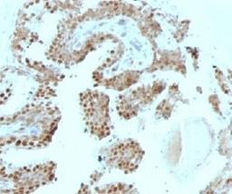 Formalin-fixed, paraffin-embedded human prostate carcinoma stained with p57Kip2 antibody (SPM308).