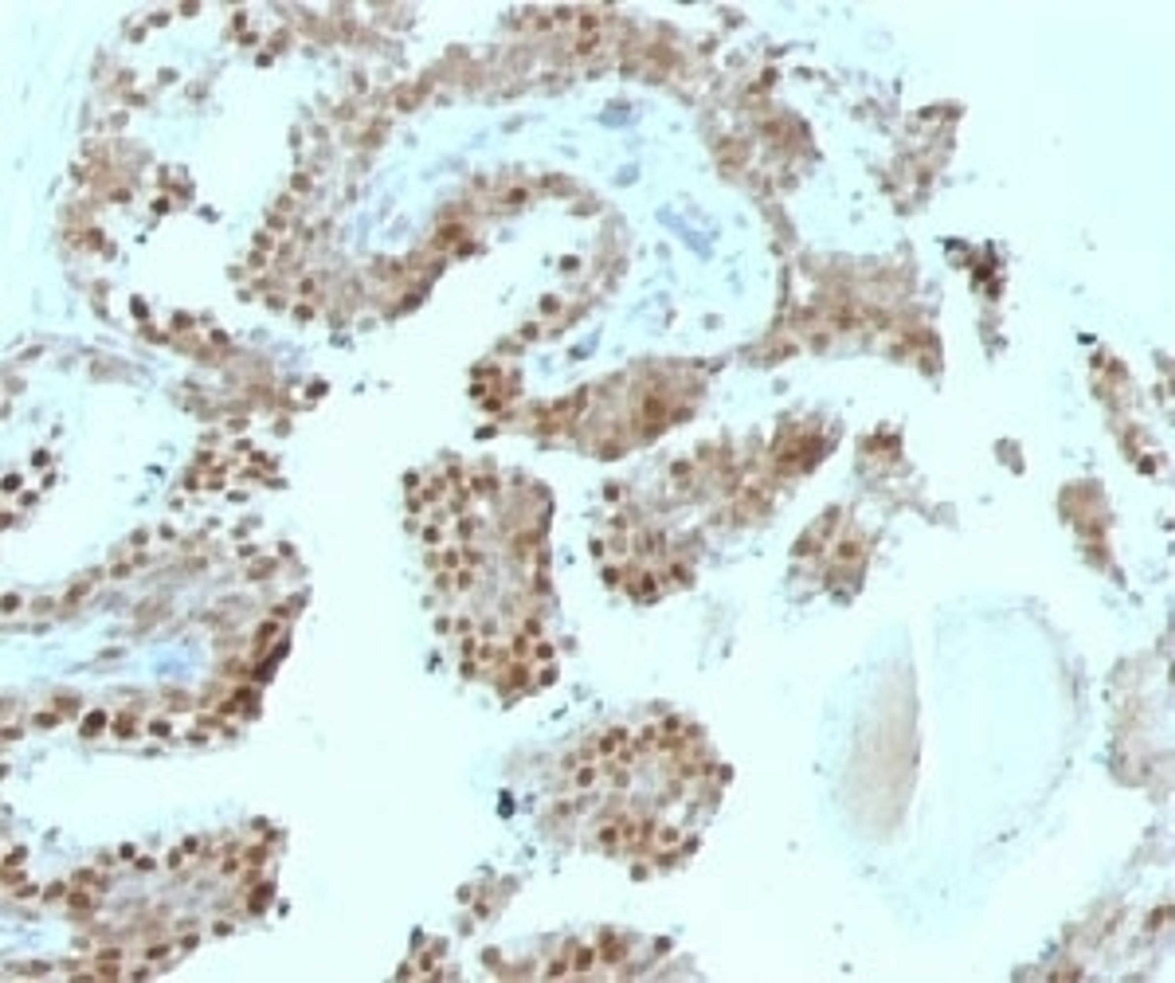 Formalin-fixed, paraffin-embedded human prostate carcinoma stained with p57Kip2 antibody (SPM308).