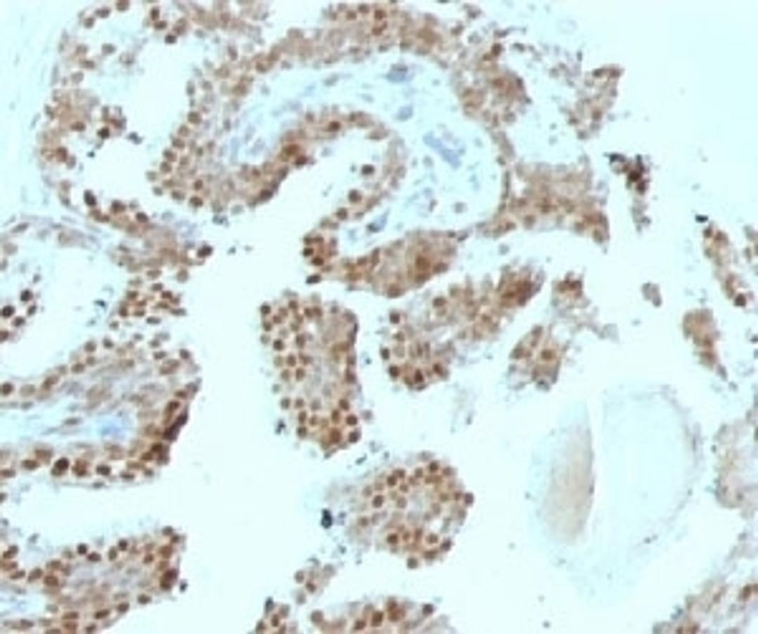 Formalin-fixed, paraffin-embedded human prostate carcinoma stained with p57Kip2 antibody (SPM308).