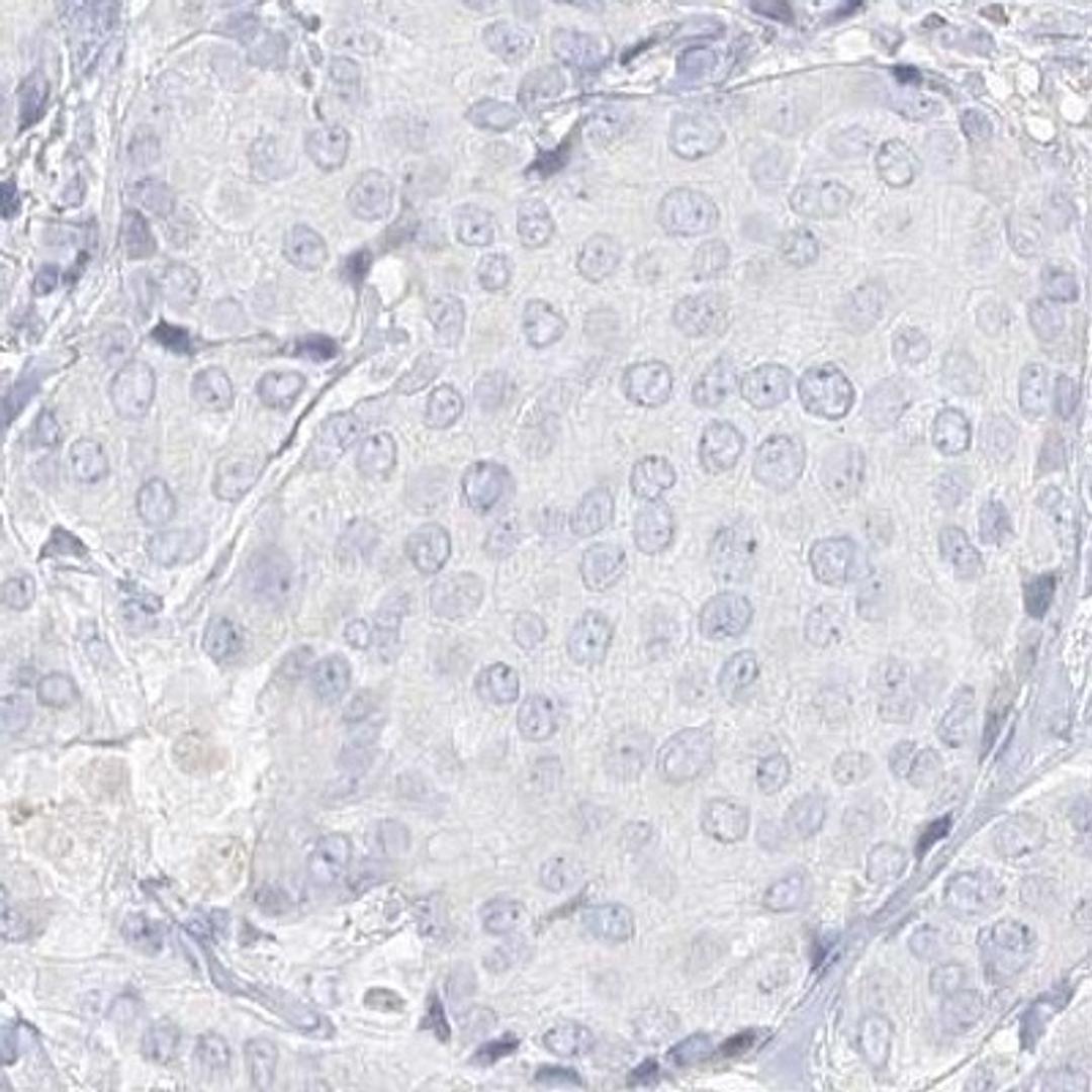 Immunohistochemistry: DMGDH Antibody [NBP2-32666] - breast cancer