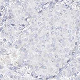 Immunohistochemistry: DMGDH Antibody [NBP2-32666] - breast cancer