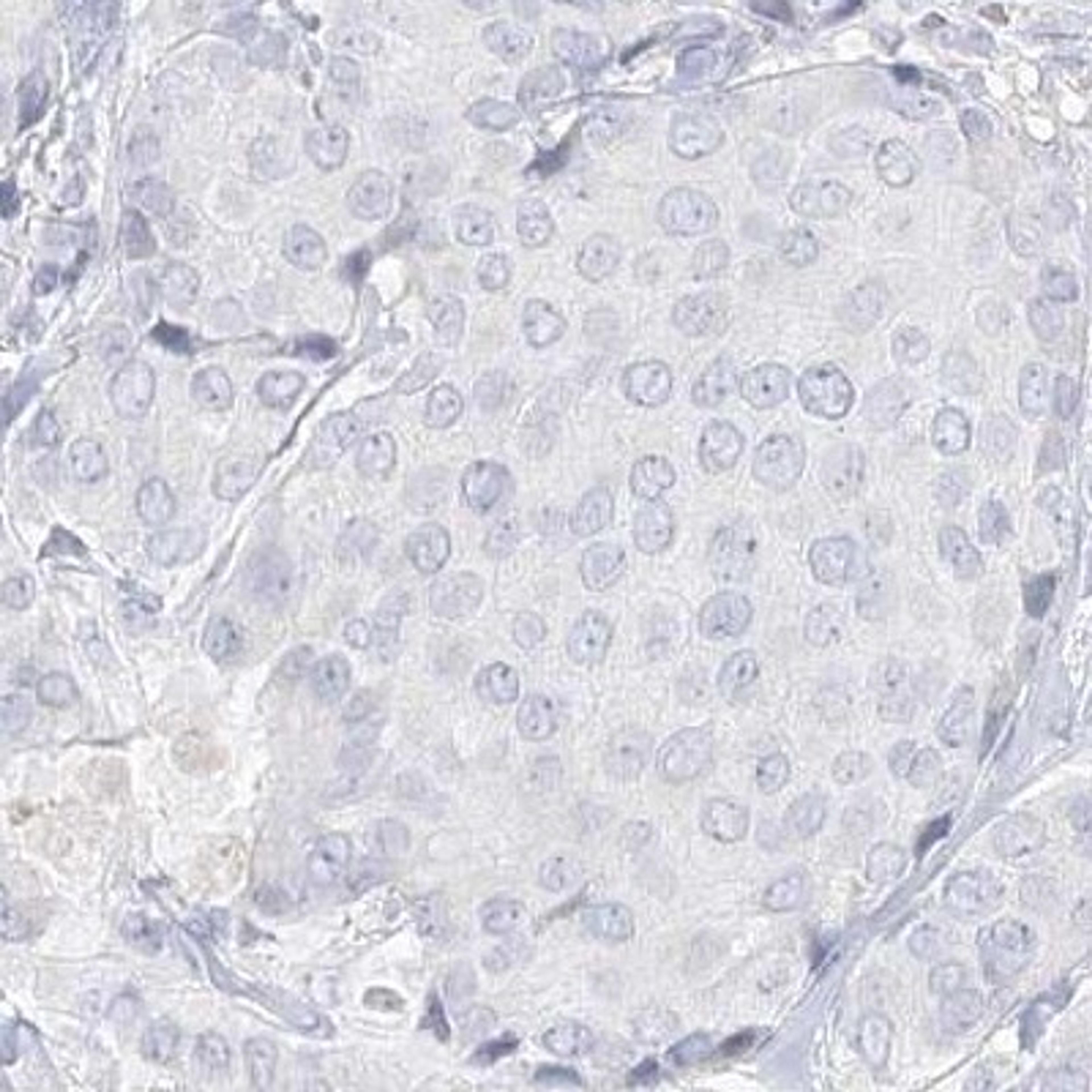 Immunohistochemistry: DMGDH Antibody [NBP2-32666] - breast cancer