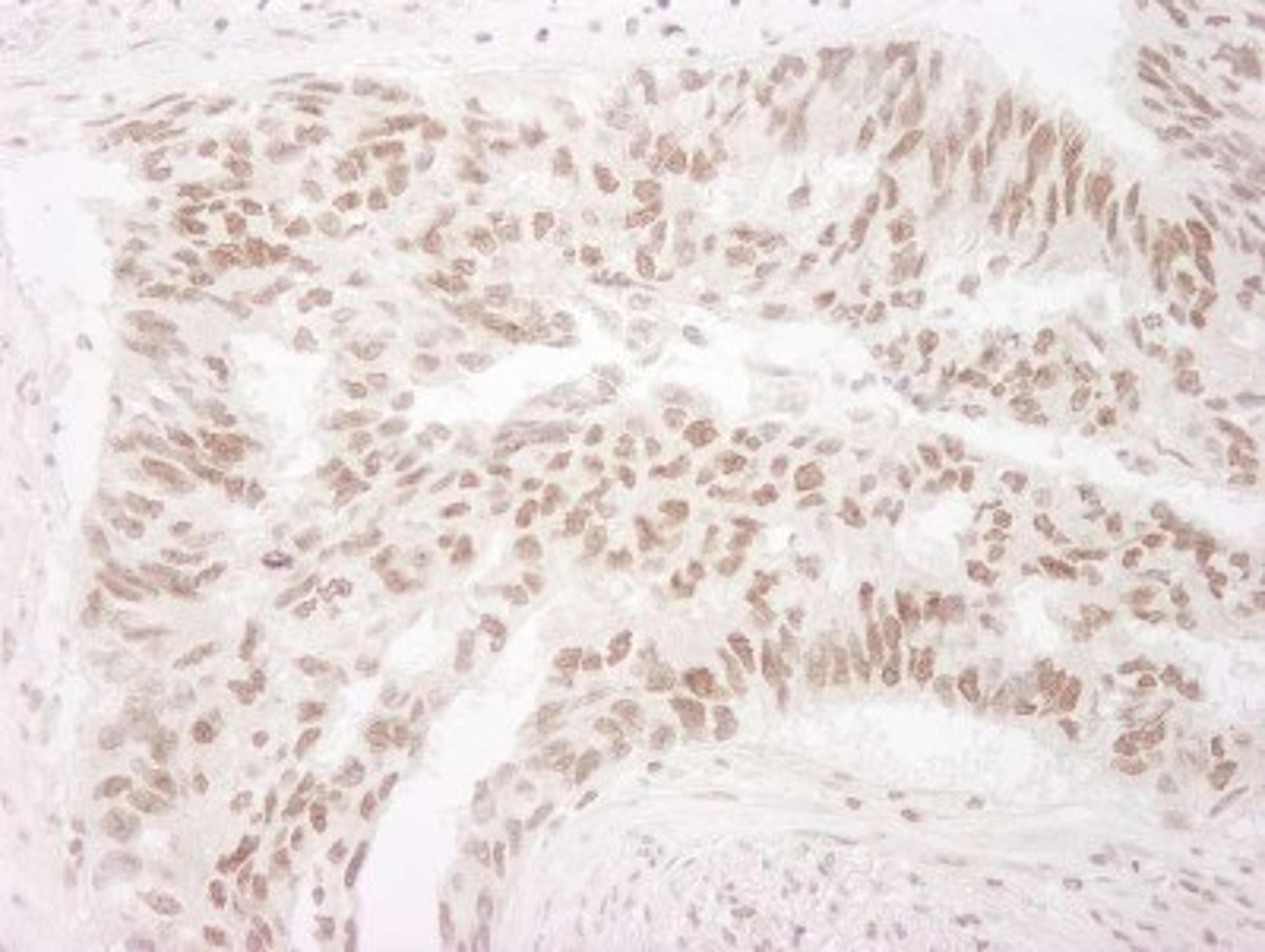 Immunohistochemistry-Paraffin: EHMT2 Antibody [NB100-40825] - Human lung carcinoma.  Antibody used at a dilution of 1:1,000.