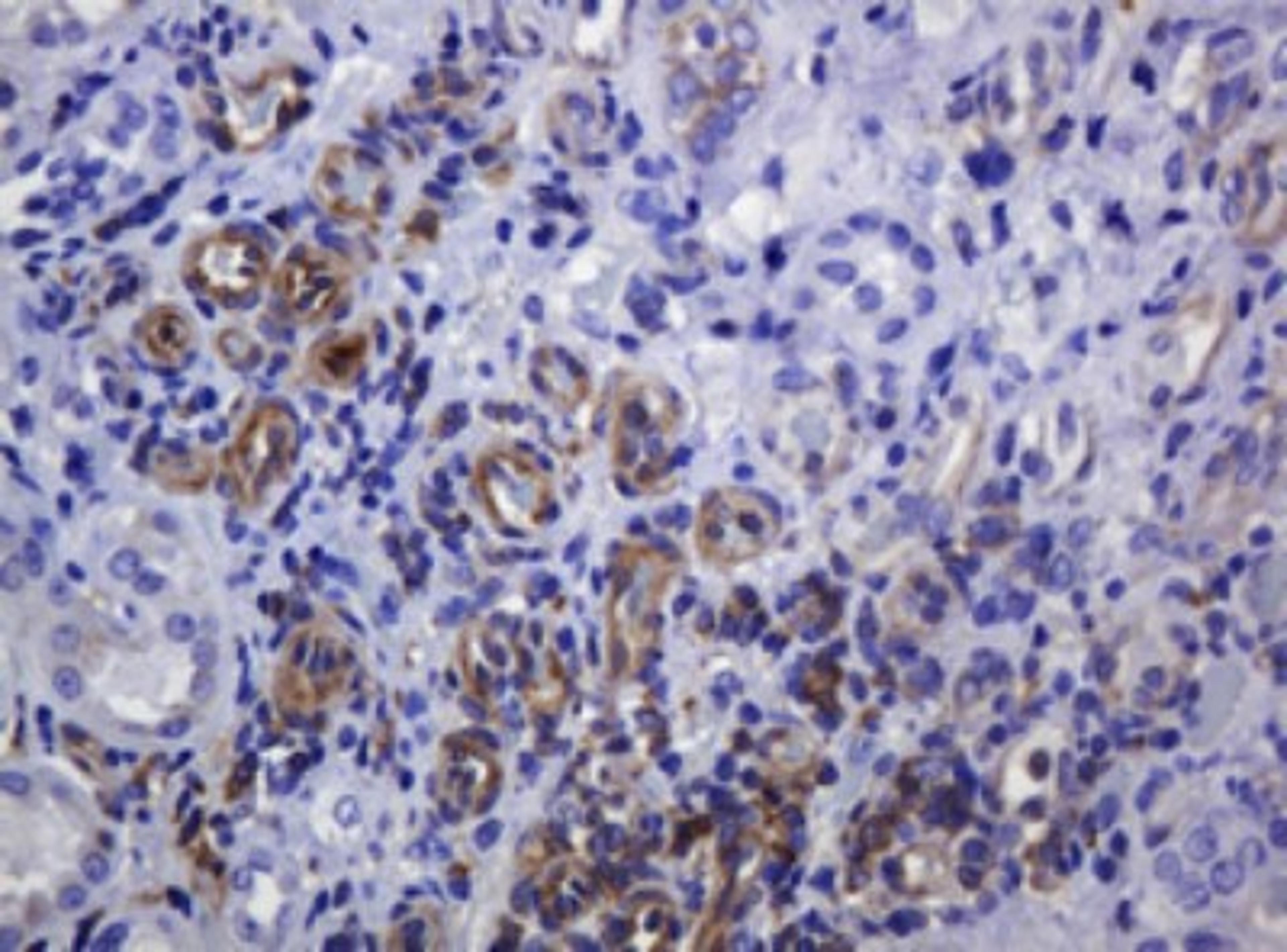 Immunohistochemistry: SOAT 2 Antibody (2D3) [NBP2-45981] - Analysis of Adenocarcinoma of Human colon tissue. (Heat-induced epitope retrieval by 10mM citric buffer, pH6.0, 120C for 3min)