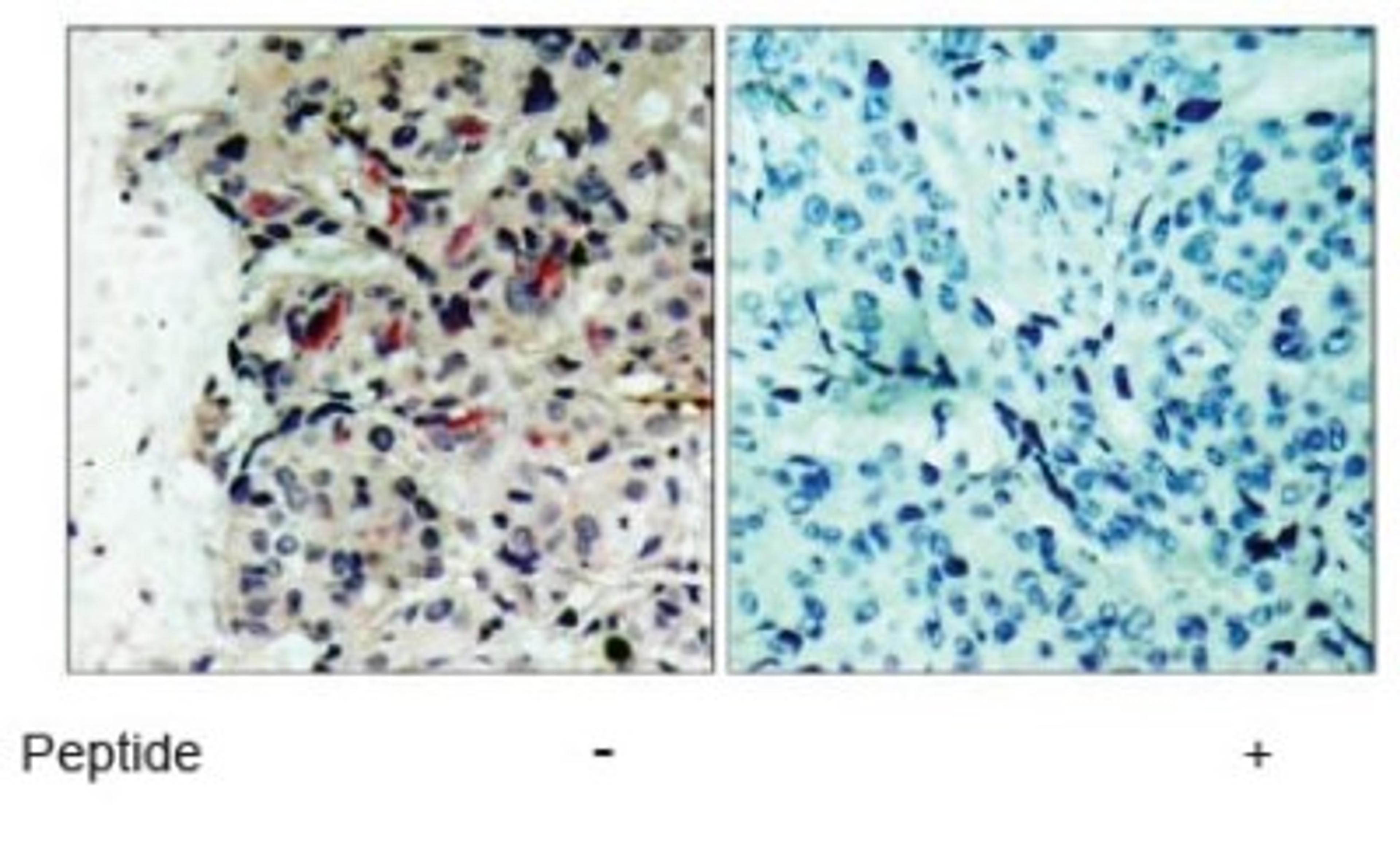 Immunohistochemistry: JAK1 Antibody [NB100-82004] - Immunohistochemical analysis of paraffin-embedded human breast carcinoma tissue using JAK1 (Ab-1022) antibody.