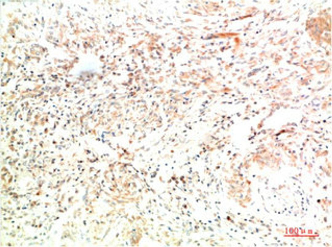 Immunohistochemical analysis of paraffin-embedded Human Lung Carcinoma Tissue using Collagen II  Mouse mAb diluted at 1:200.