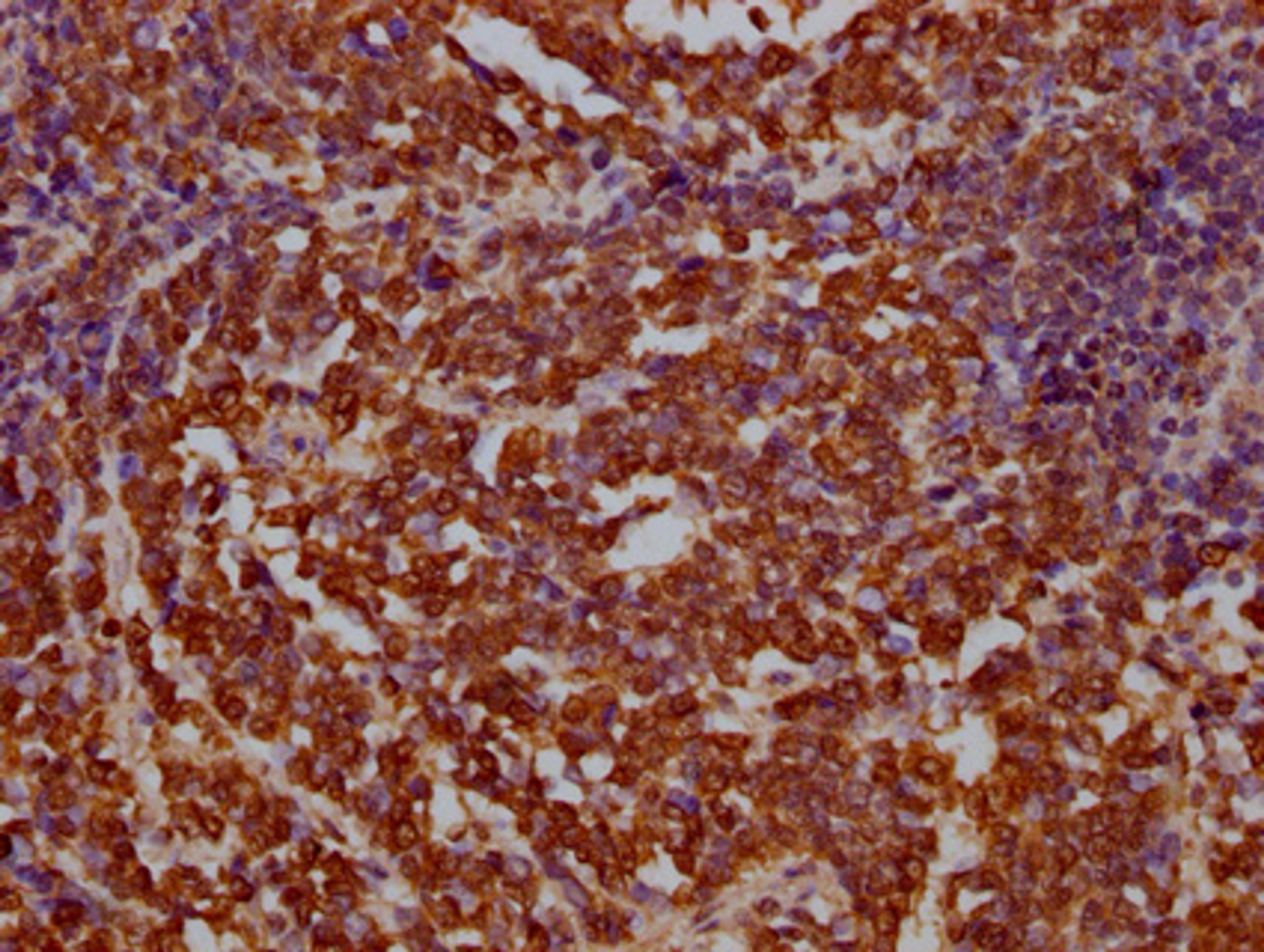IHC image of CSB-PA002531LA01HU diluted at 1:100 and staining in paraffin-embedded human lung cancer performed on a Leica BondTM system. After dewaxing and hydration, antigen retrieval was mediated by high pressure in a citrate buffer (pH 6.0). Section was blocked with 10% normal goat serum 30min at RT. Then primary antibody (1% BSA) was incubated at 4°C overnight. The primary is detected by a Goat anti-rabbit IgG labeled by HRP and visualized using 0.05% DAB.