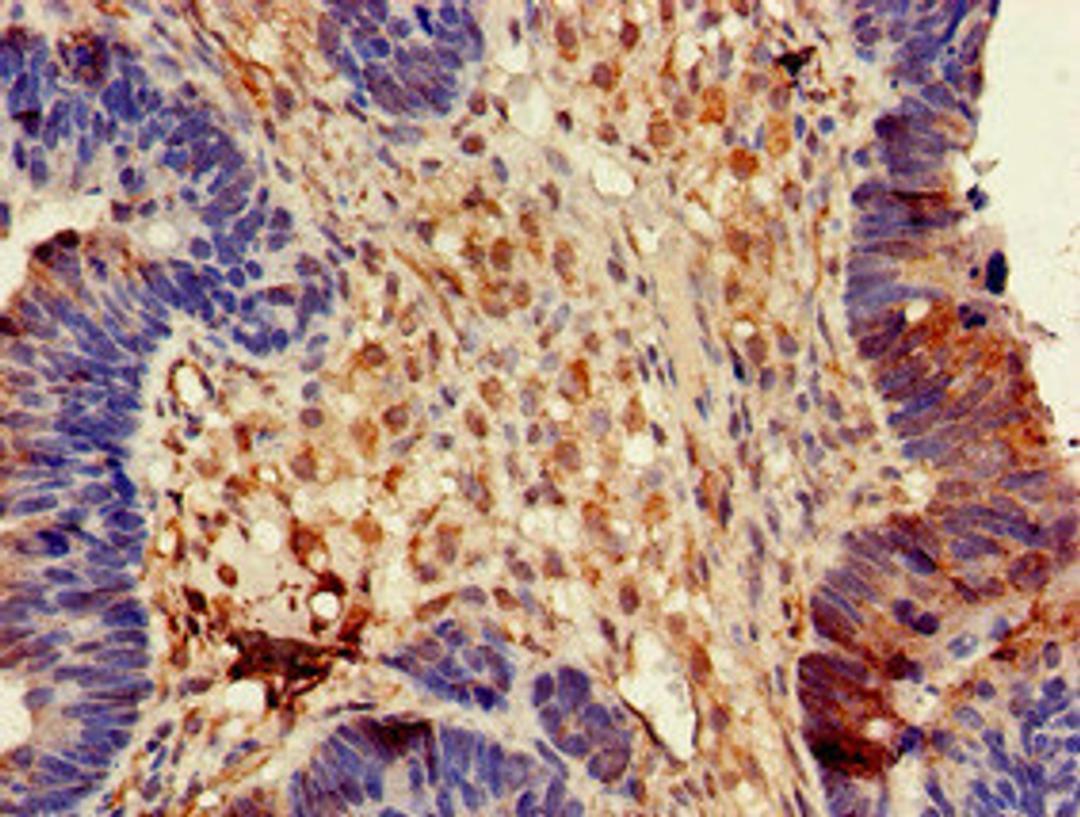 Immunohistochemistry of paraffin-embedded human ovarian cancer using CSB-PA007172LA01HU at dilution of 1:100