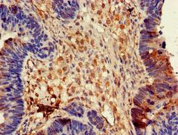 Immunohistochemistry of paraffin-embedded human ovarian cancer using CSB-PA007172LA01HU at dilution of 1:100