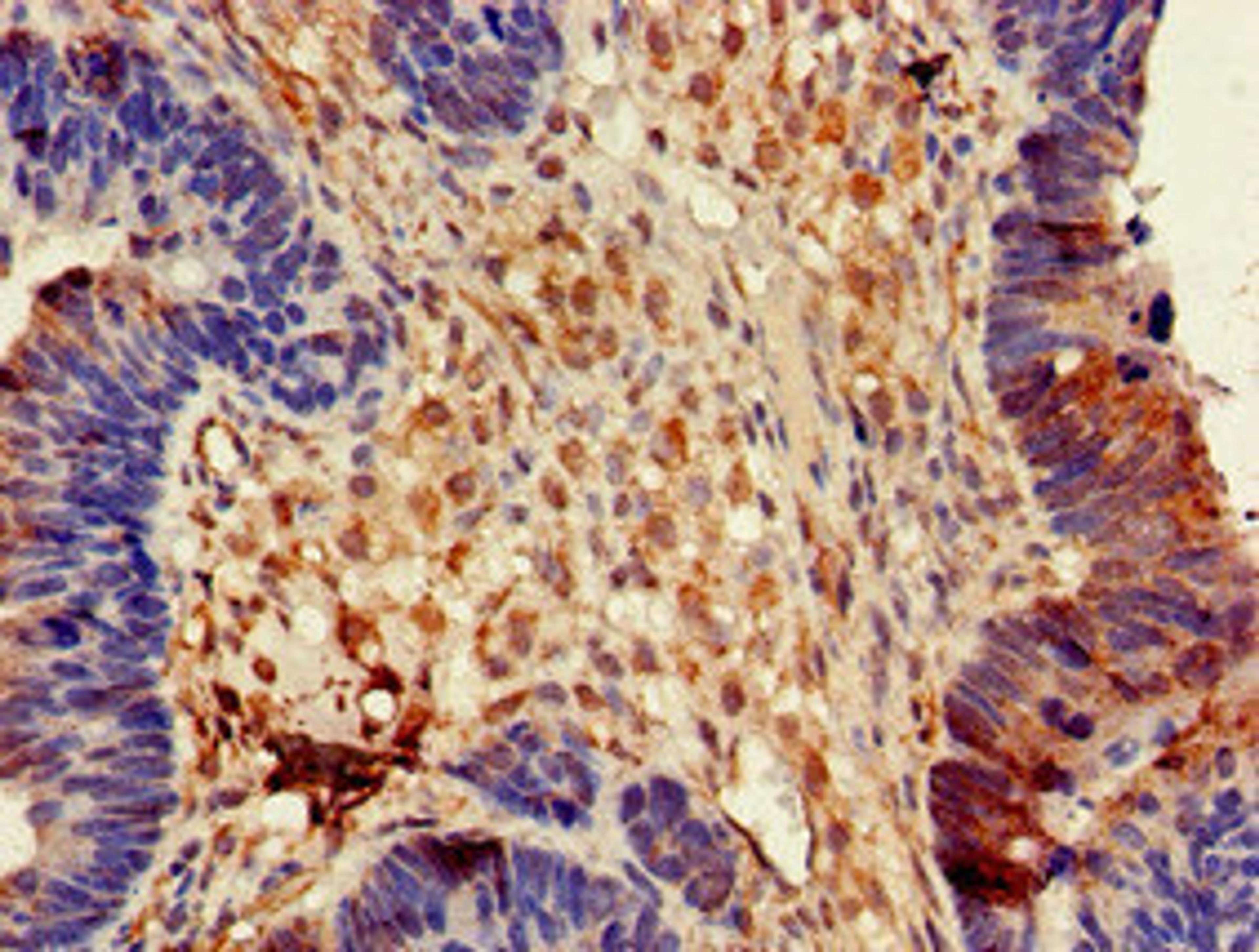 Immunohistochemistry of paraffin-embedded human ovarian cancer using CSB-PA007172LA01HU at dilution of 1:100