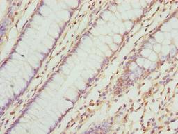 Immunohistochemistry of paraffin-embedded human colon cancer using CSB-PA023713LA01HU at dilution of 1:100