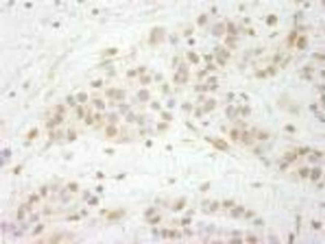 Immunohistochemistry-Paraffin: MTA3 Antibody [NB100-2306] - FFPE section of human breast carcinoma.  Affinity purified rabbit anti-MTA3 used at a dilution of 1:250.