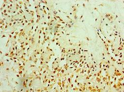 Immunohistochemistry of paraffin-embedded human breast cancer using CSB-PA773028ESR2HU at dilution of 1:100