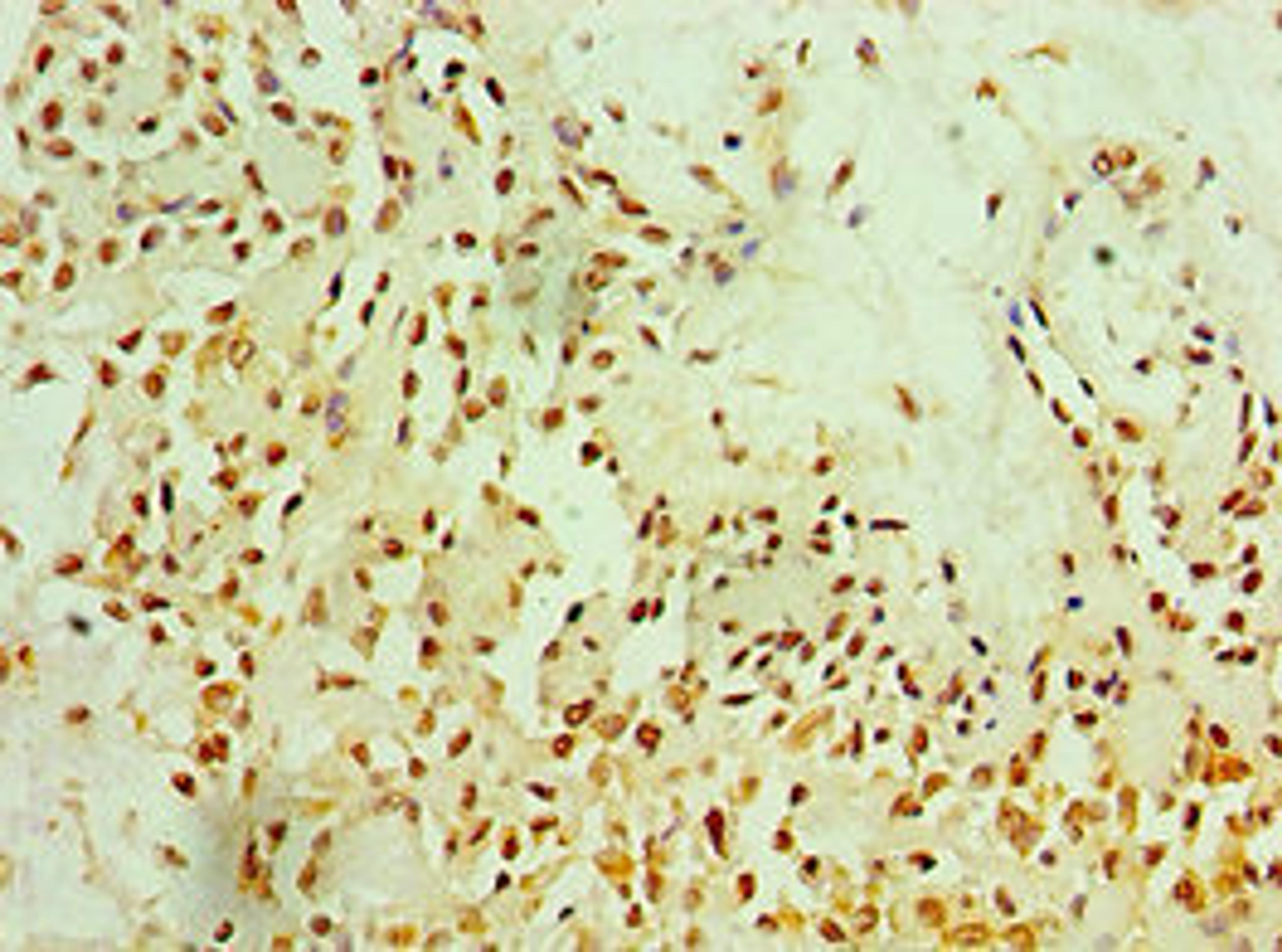 Immunohistochemistry of paraffin-embedded human breast cancer using CSB-PA773028ESR2HU at dilution of 1:100