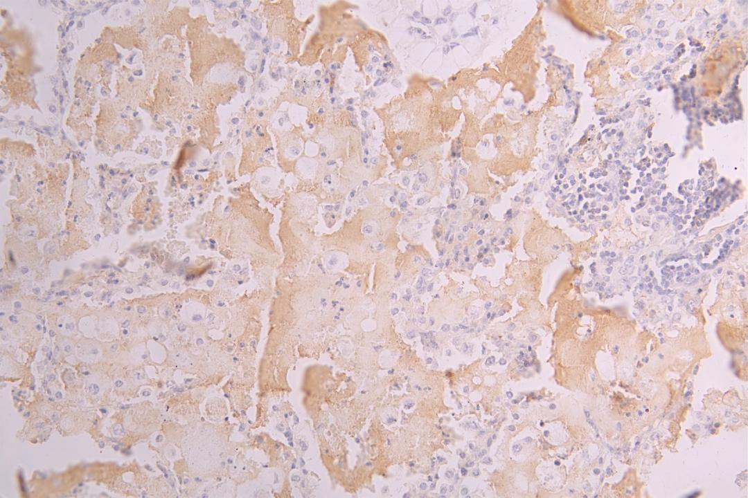 IHC image of CSB-RA624122MA1HU diluted at 1：150 and staining in paraffin-embedded human lung tissue performed on a Leica BondTM system. After dewaxing and hydration, antigen retrieval was mediated by high pressure in a citrate buffer (pH 6.0). Section was blocked with 10% normal goat serum 30min at RT. Then primary antibody (1% BSA) was incubated at 4°C overnight. The primary is detected by a Goat anti-human polymer IgG labeled by HRP and visualized using 0.05% DAB.
