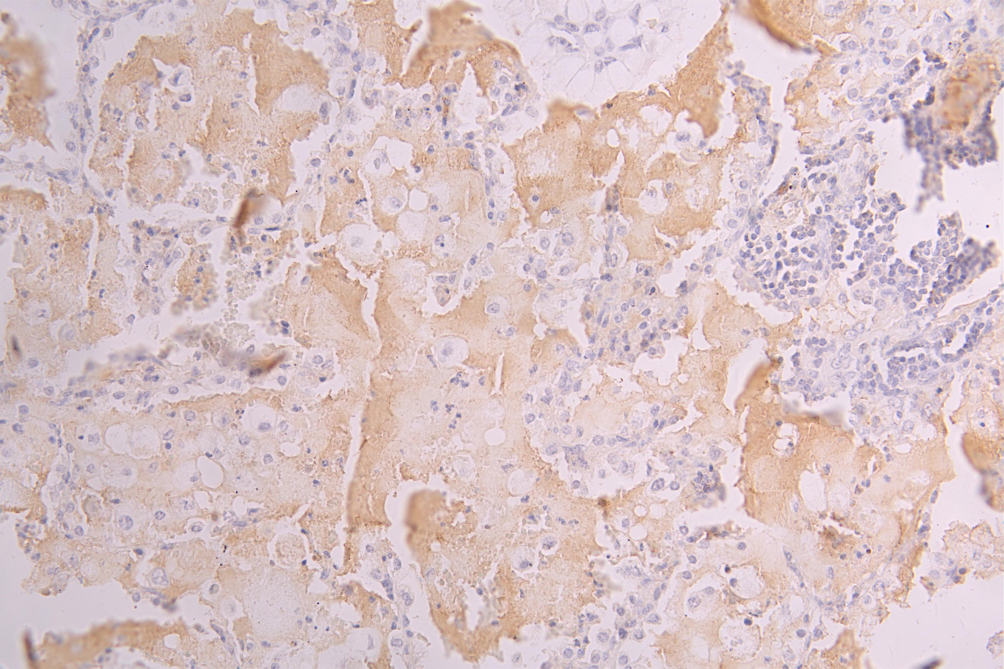 IHC image of CSB-RA624122MA1HU diluted at 1：150 and staining in paraffin-embedded human lung tissue performed on a Leica BondTM system. After dewaxing and hydration, antigen retrieval was mediated by high pressure in a citrate buffer (pH 6.0). Section was blocked with 10% normal goat serum 30min at RT. Then primary antibody (1% BSA) was incubated at 4°C overnight. The primary is detected by a Goat anti-human polymer IgG labeled by HRP and visualized using 0.05% DAB.