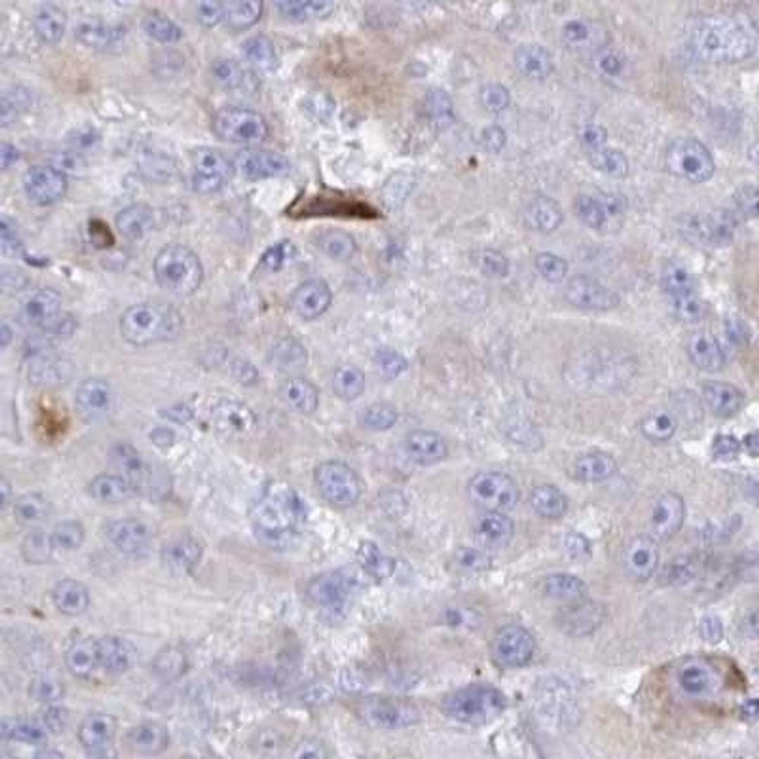 Immunohistochemistry: ITIH2 Antibody [NBP2-31750] - liver cancer