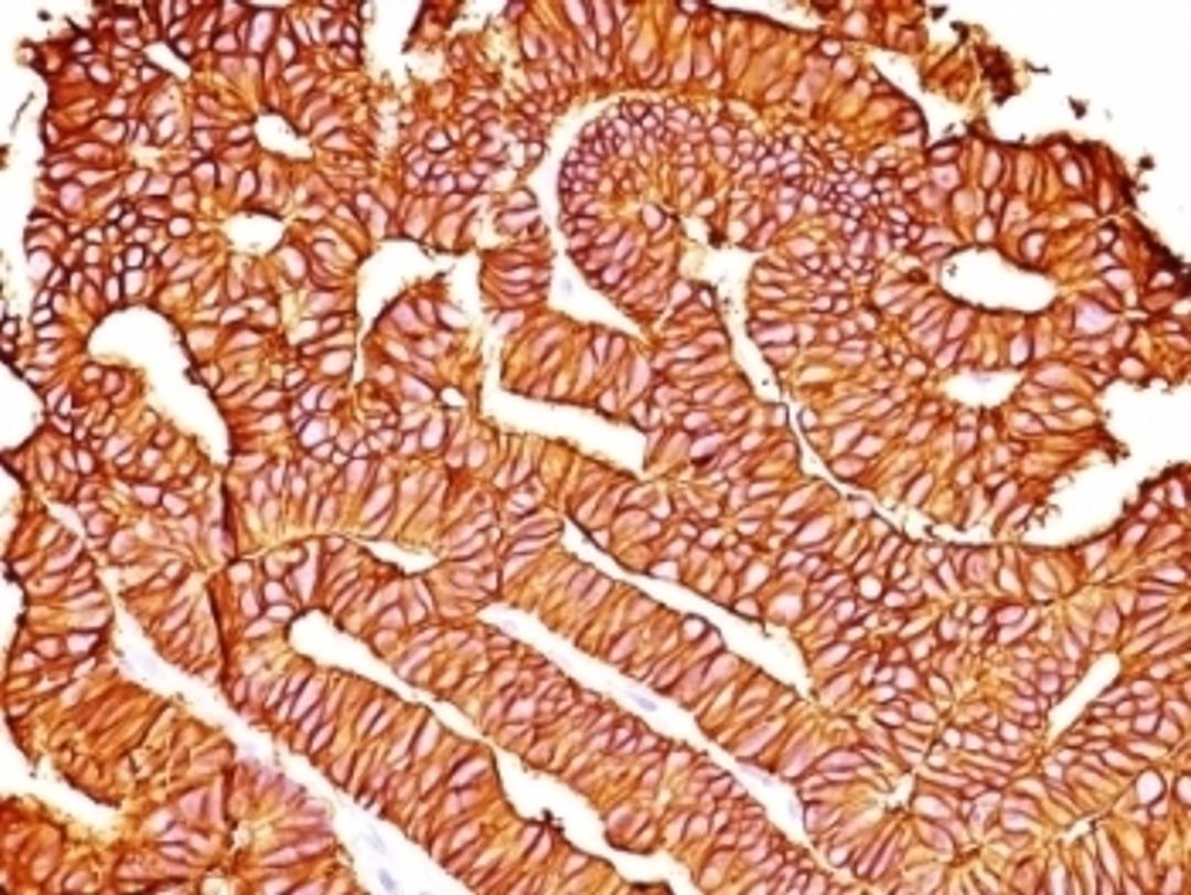 Formalin-fixed, paraffin-embedded human colon carcinoma stained with EpCAM antibody (SPM528).