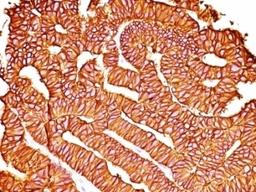 Formalin-fixed, paraffin-embedded human colon carcinoma stained with EpCAM antibody (SPM528).