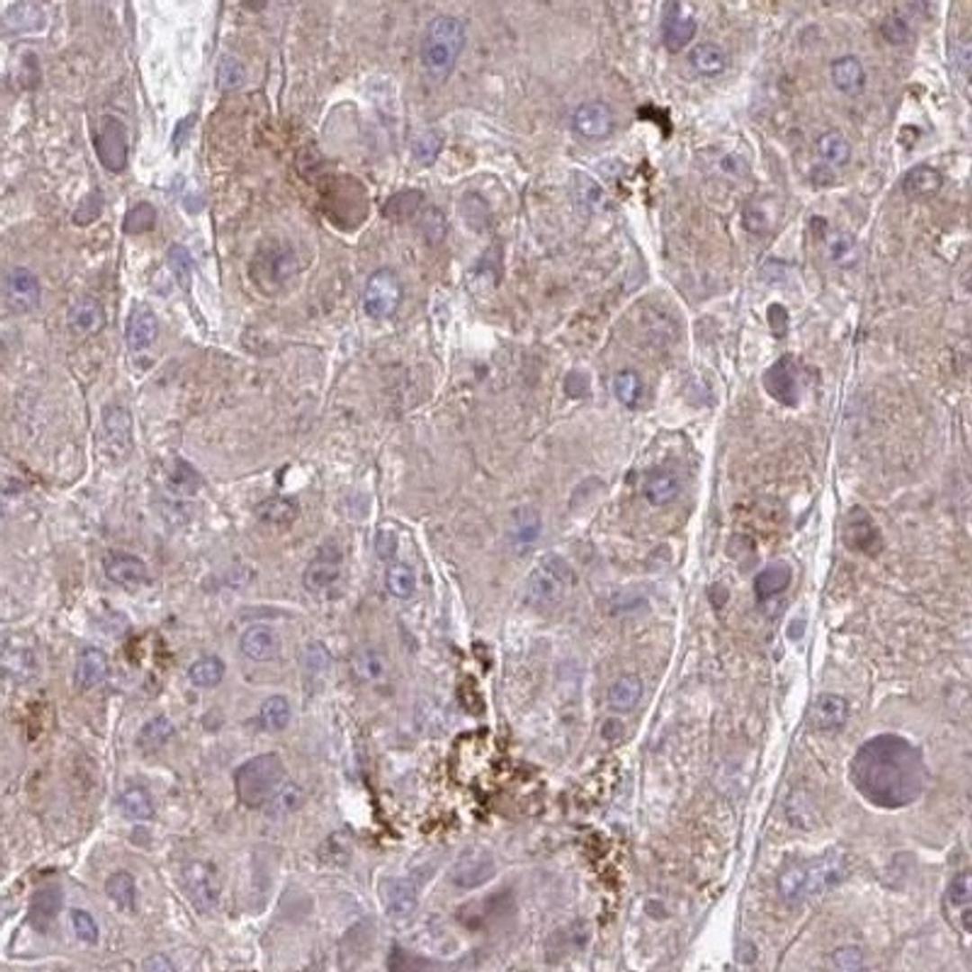 Immunohistochemistry: ADAM21 Antibody [NBP2-32414] - liver cancer