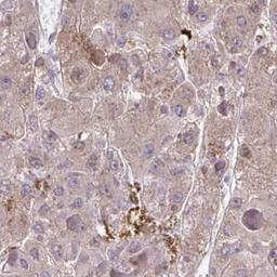 Immunohistochemistry: ADAM21 Antibody [NBP2-32414] - liver cancer